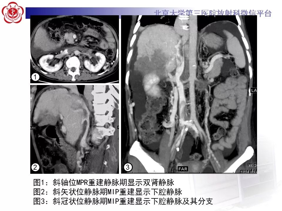 影像PPT - 【PPT】布-加综合征-8