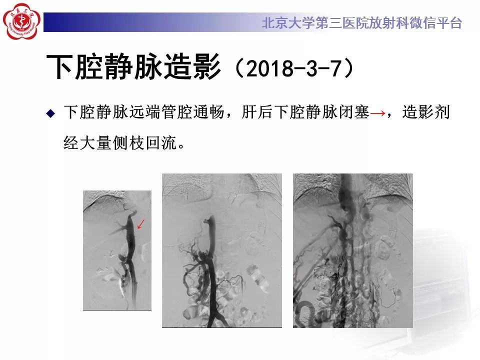 影像PPT - 【PPT】布-加综合征-12
