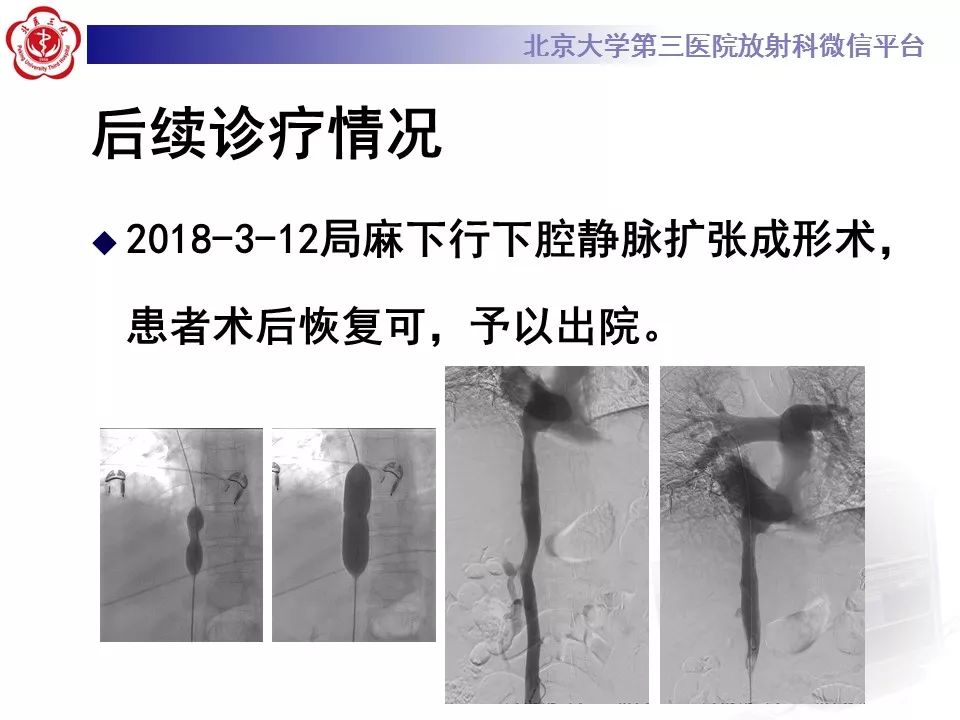 影像PPT - 【PPT】布-加综合征-13