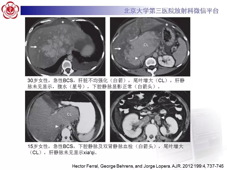 影像PPT - 【PPT】布-加综合征-30