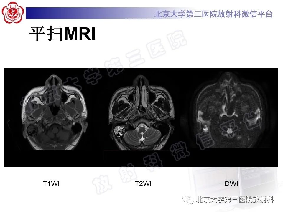 影像PPT - 【PPT】鼻咽结核-4