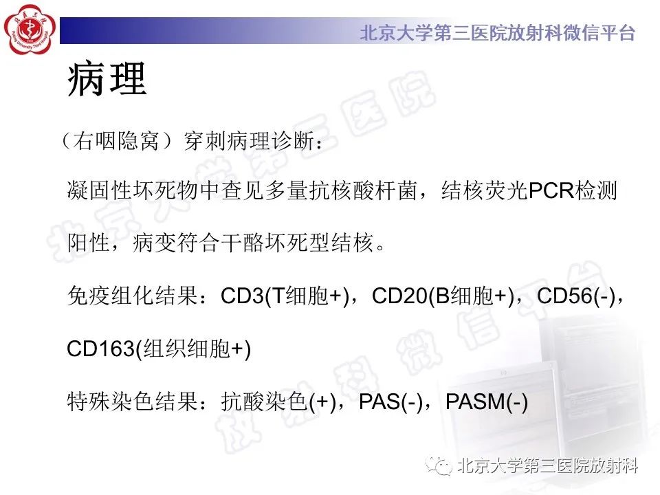 影像PPT - 【PPT】鼻咽结核-8