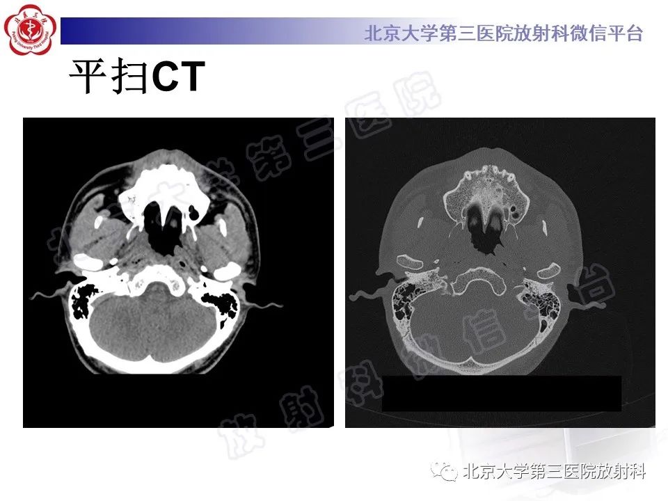 影像PPT - 【PPT】鼻咽结核-3