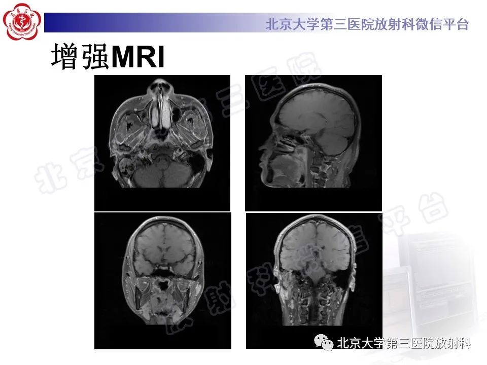 影像PPT - 【PPT】鼻咽结核-5