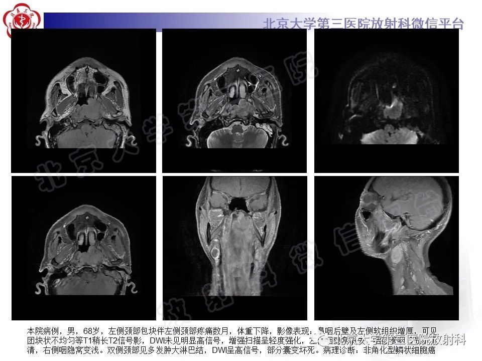 影像PPT - 【PPT】鼻咽结核-17