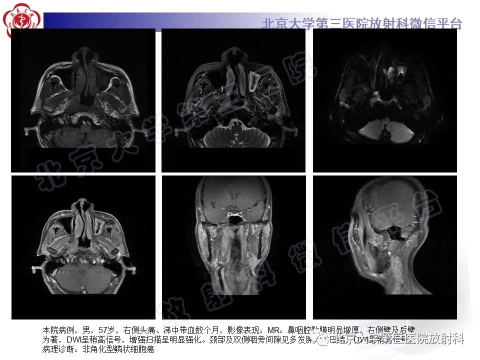 影像PPT - 【PPT】鼻咽结核-16