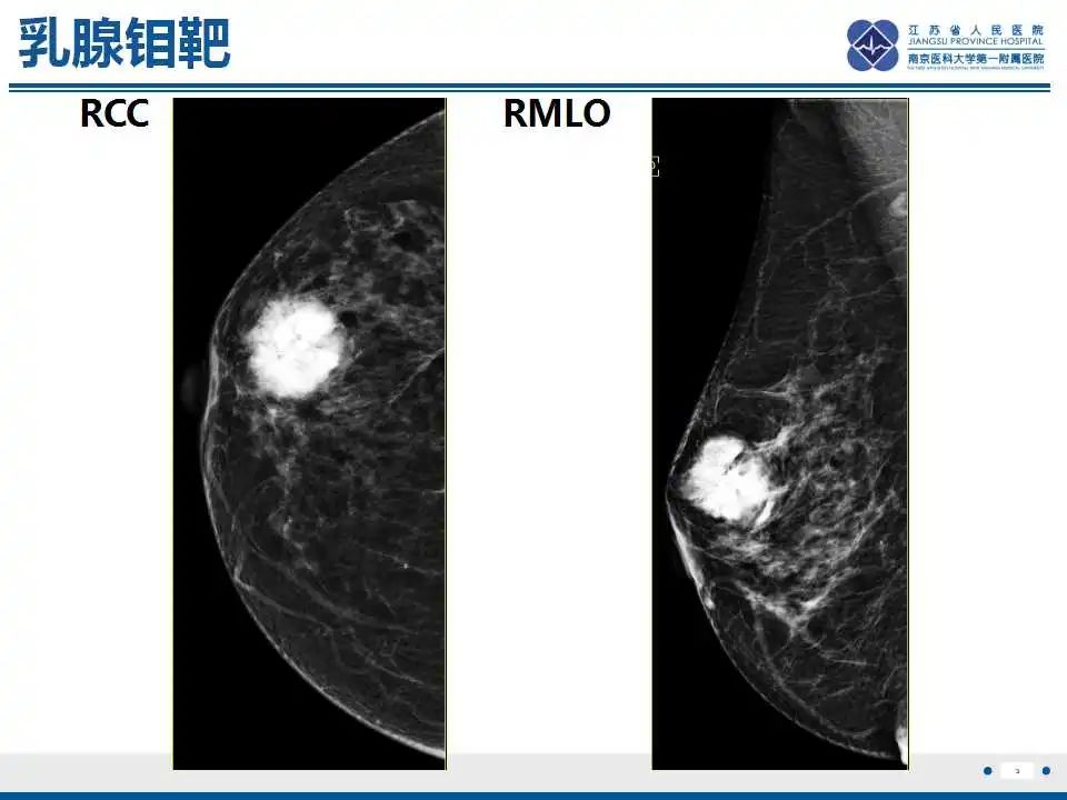 影像PPT - 【PPT】乳腺原发性骨肉瘤-4