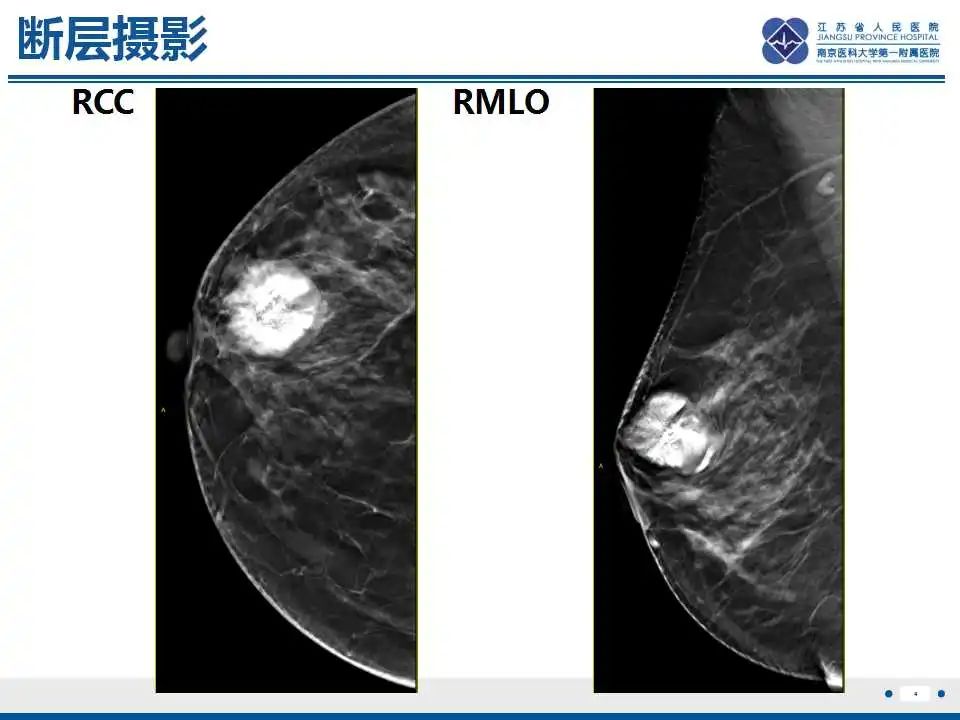 影像PPT - 【PPT】乳腺原发性骨肉瘤-5