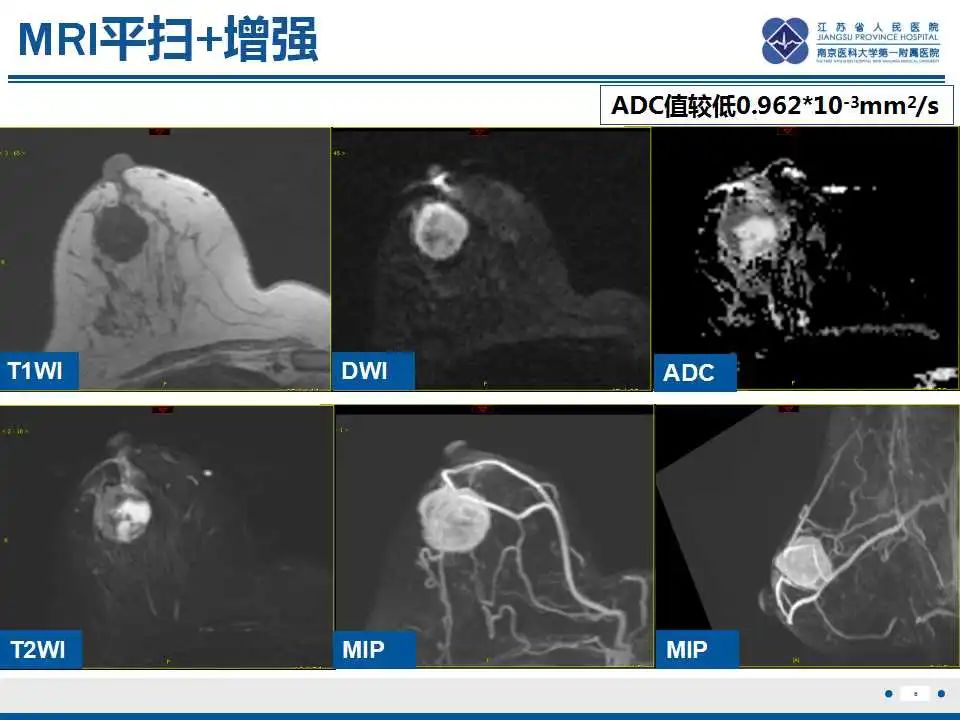 影像PPT - 【PPT】乳腺原发性骨肉瘤-7