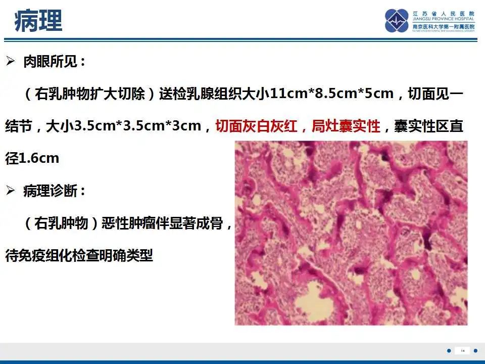 影像PPT - 【PPT】乳腺原发性骨肉瘤-15
