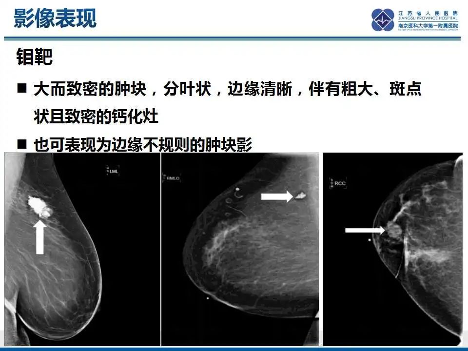 影像PPT - 【PPT】乳腺原发性骨肉瘤-27