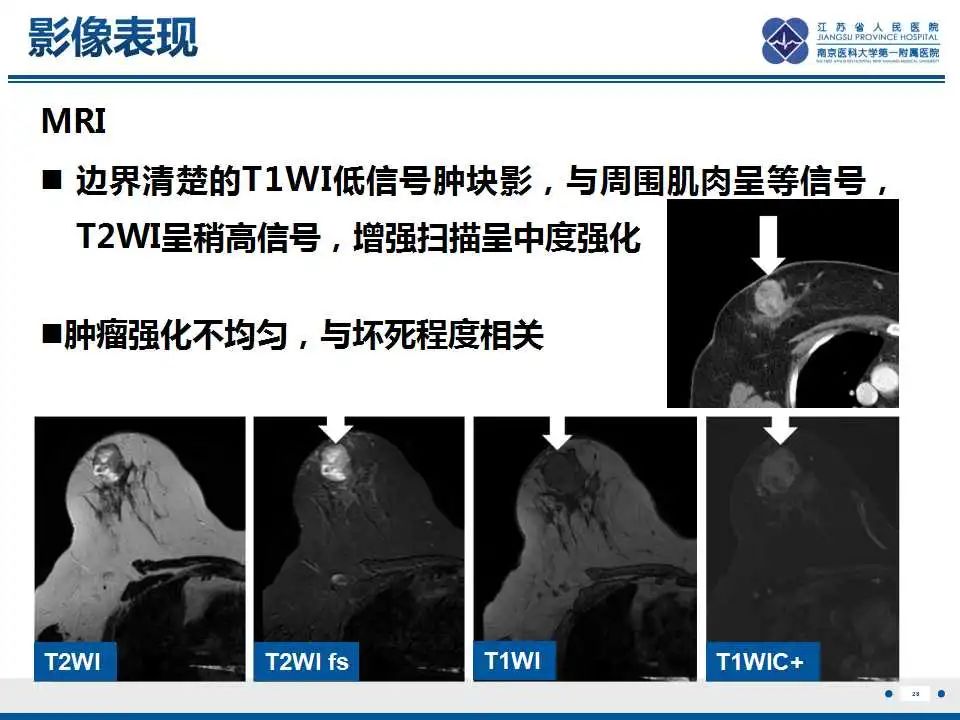 影像PPT - 【PPT】乳腺原发性骨肉瘤-29