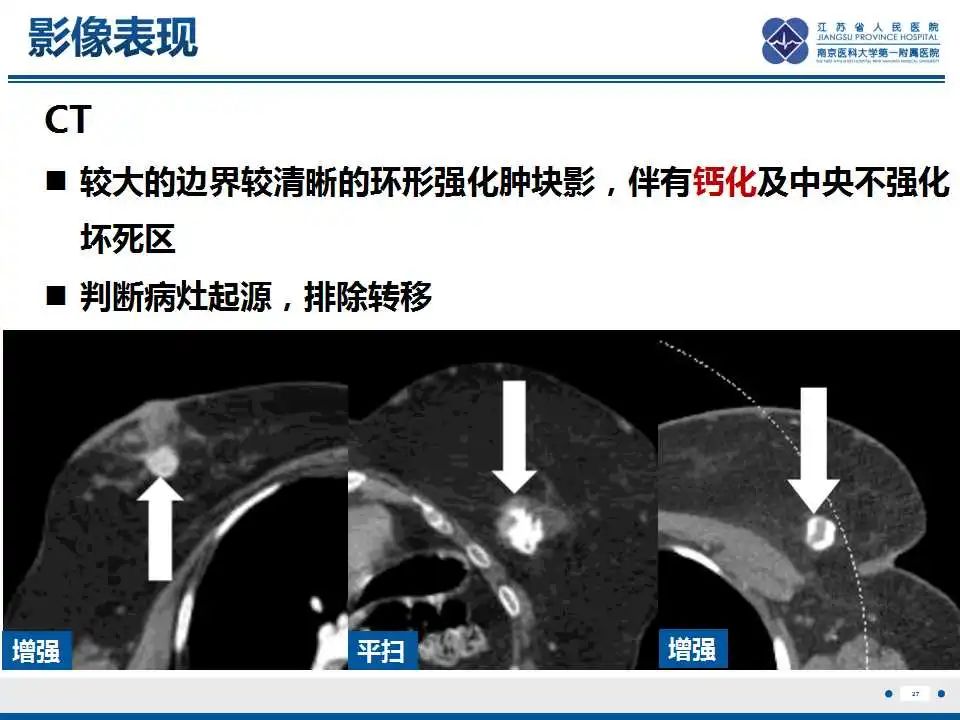影像PPT - 【PPT】乳腺原发性骨肉瘤-28