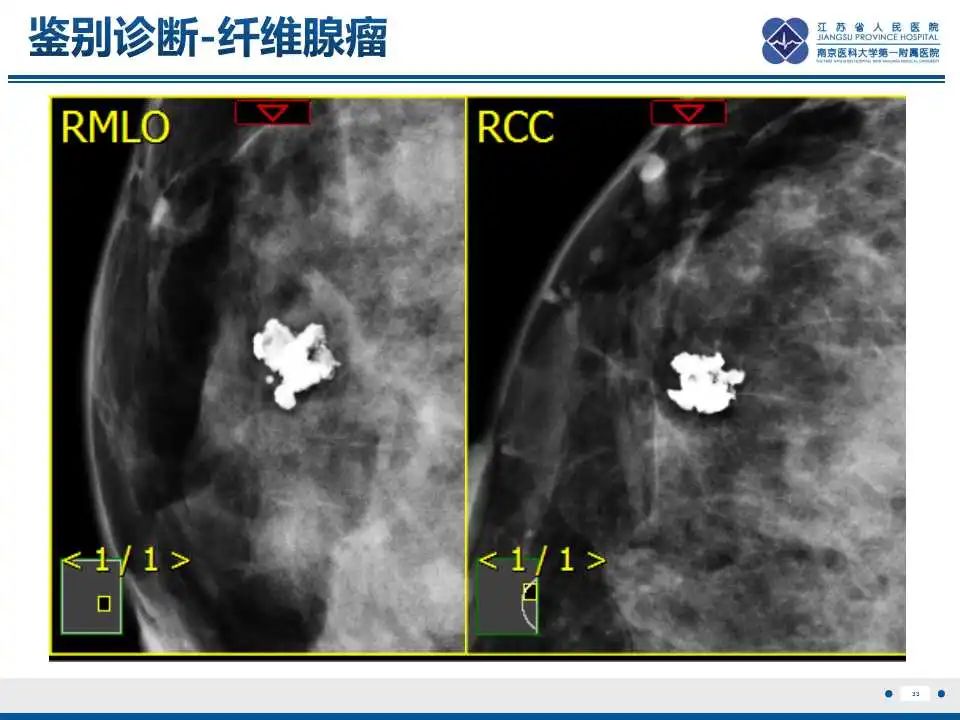 影像PPT - 【PPT】乳腺原发性骨肉瘤-34