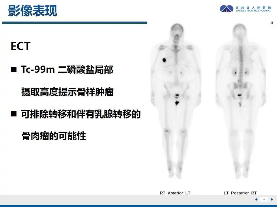 影像PPT - 【PPT】乳腺原发性骨肉瘤-30
