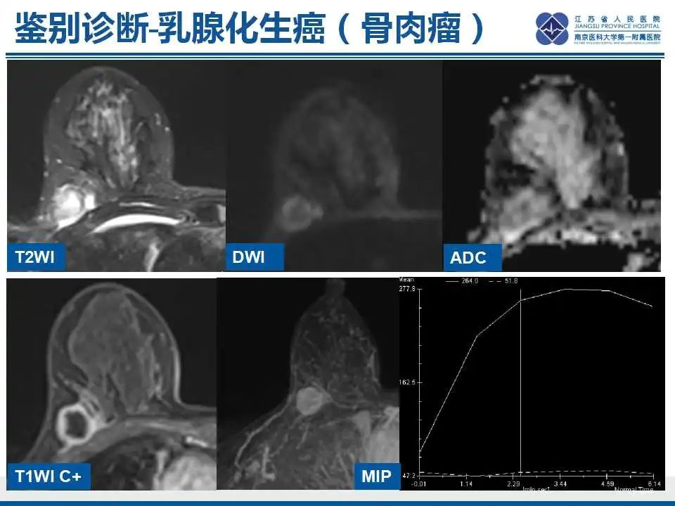 影像PPT - 【PPT】乳腺原发性骨肉瘤-37