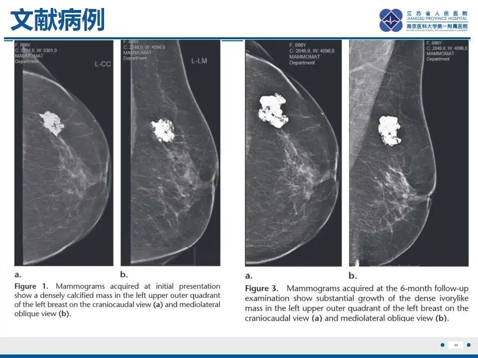 影像PPT - 【PPT】乳腺原发性骨肉瘤-31