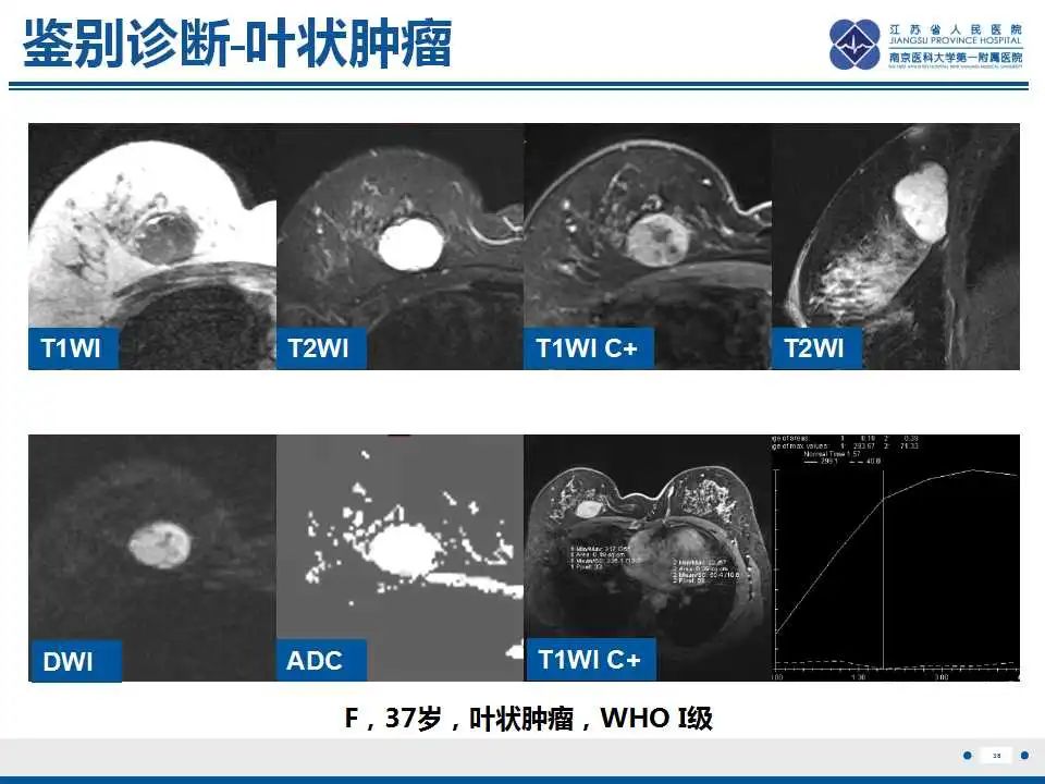 影像PPT - 【PPT】乳腺原发性骨肉瘤-39