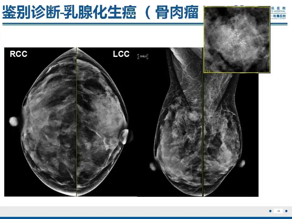 影像PPT - 【PPT】乳腺原发性骨肉瘤-36