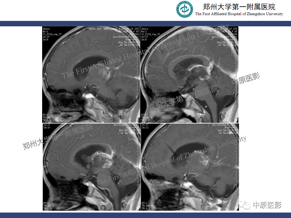 影像PPT - 【病例】松果体母细胞瘤1例CT及MR影像-6