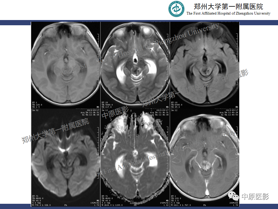 影像PPT - 【病例】松果体母细胞瘤1例CT及MR影像-5