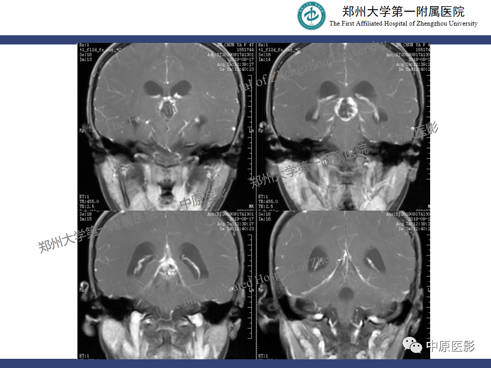影像PPT - 【病例】松果体母细胞瘤1例CT及MR影像-7