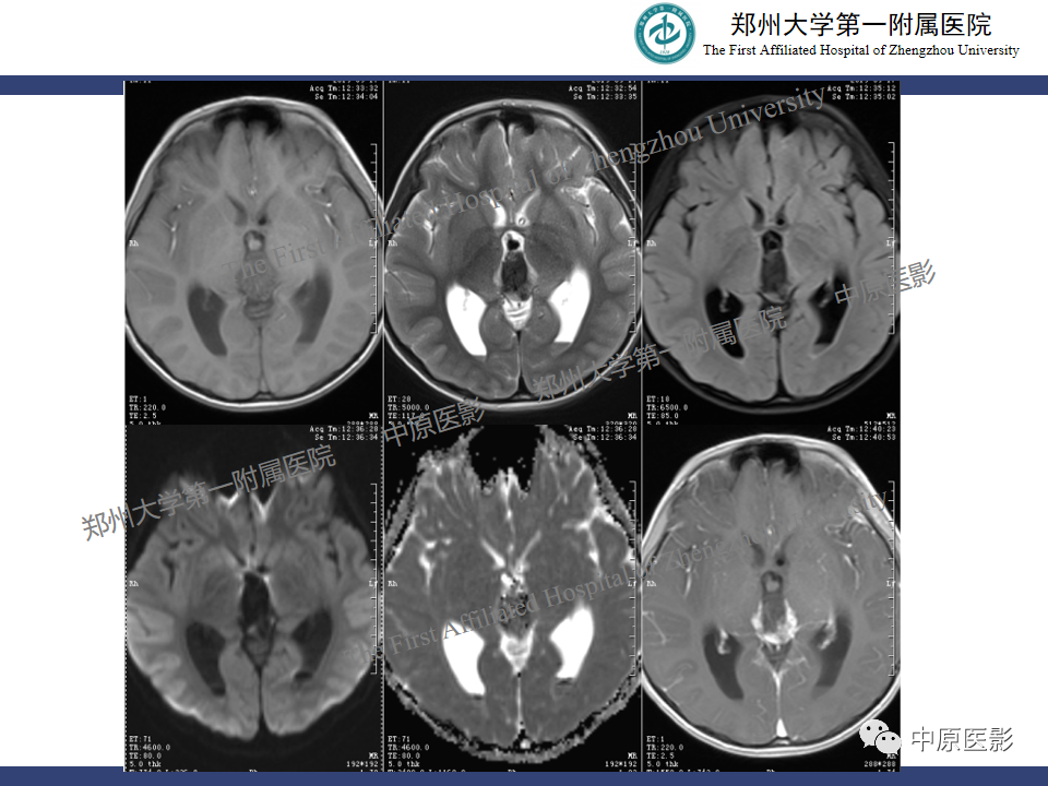 影像PPT - 【病例】松果体母细胞瘤1例CT及MR影像-4