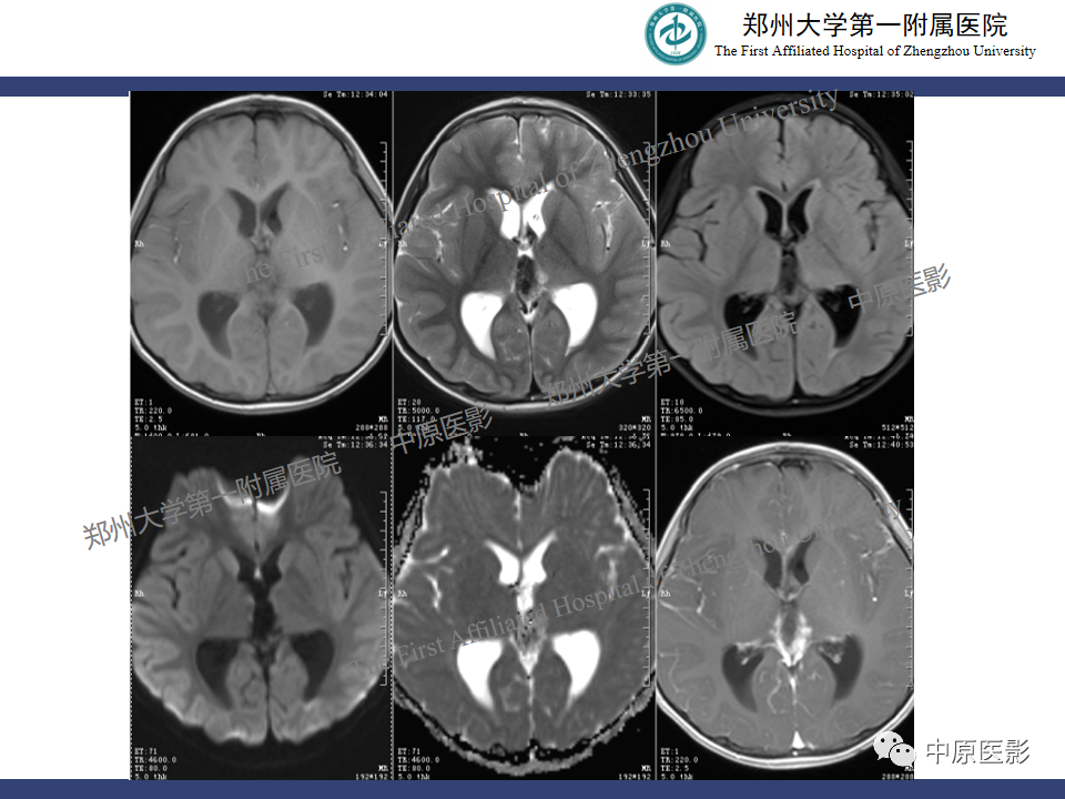 影像PPT - 【病例】松果体母细胞瘤1例CT及MR影像-3
