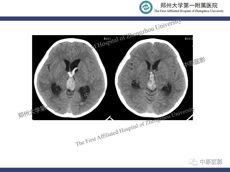 影像PPT - 【病例】松果体母细胞瘤1例CT及MR影像-8