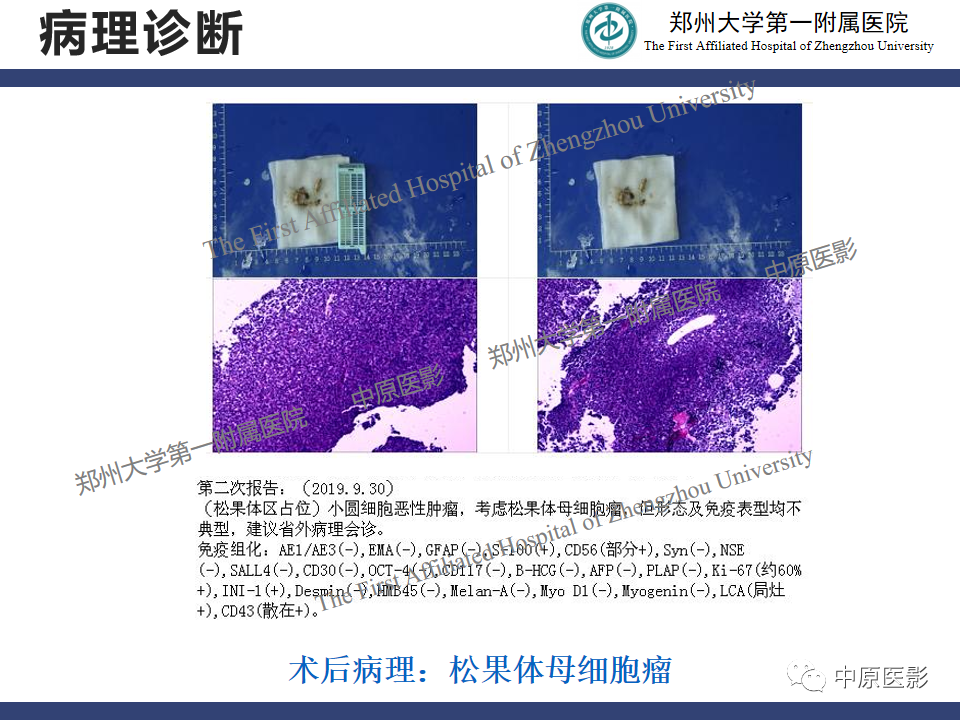 影像PPT - 【病例】松果体母细胞瘤1例CT及MR影像-11