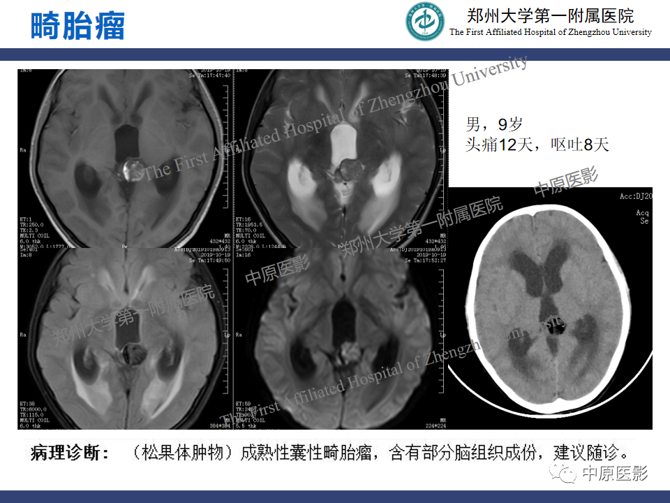 影像PPT - 【病例】松果体母细胞瘤1例CT及MR影像-19