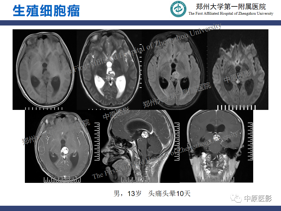 影像PPT - 【病例】松果体母细胞瘤1例CT及MR影像-17