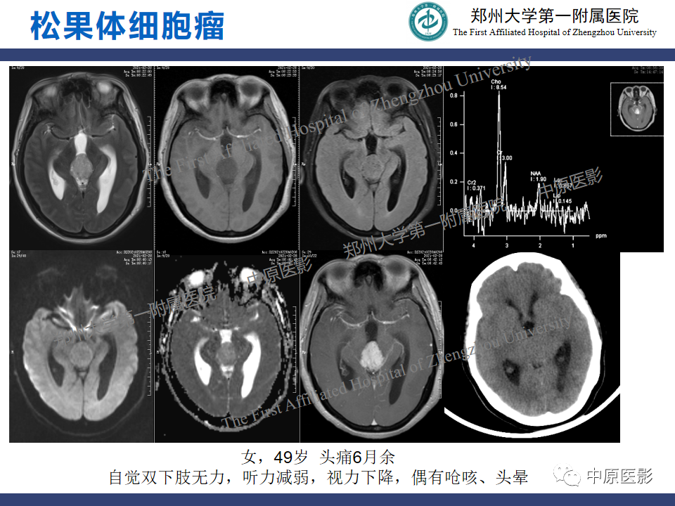 影像PPT - 【病例】松果体母细胞瘤1例CT及MR影像-21