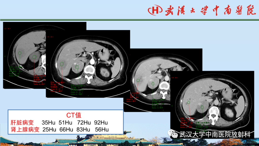 影像PPT - 【PPT】腹盆病例讨论（肾上腺）-5