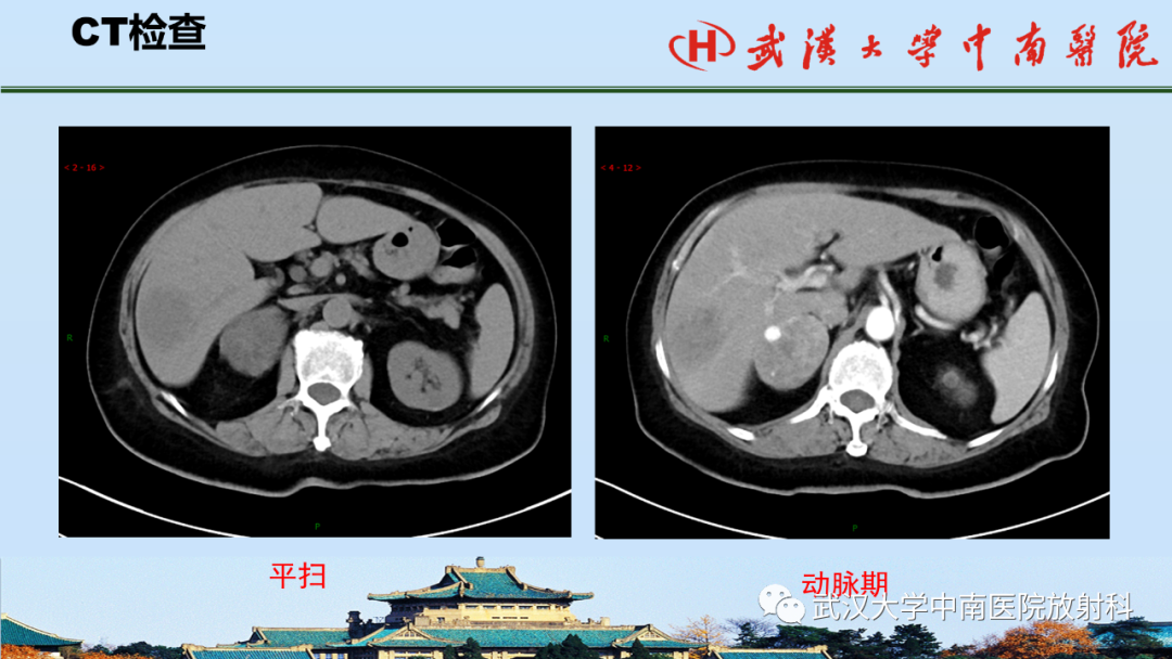 影像PPT - 【PPT】腹盆病例讨论（肾上腺）-3