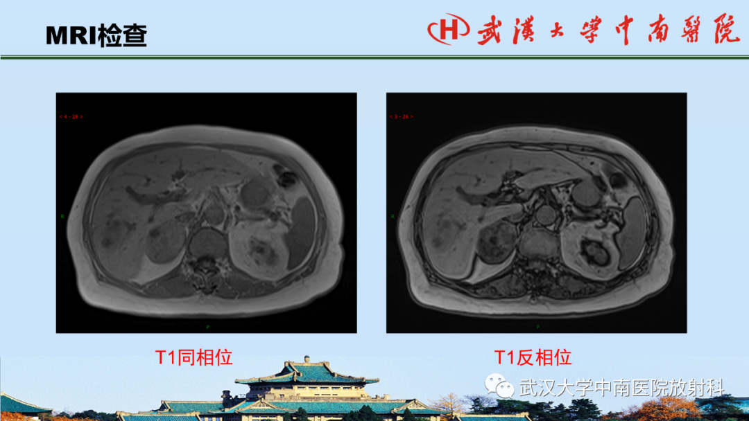 影像PPT - 【PPT】腹盆病例讨论（肾上腺）-6