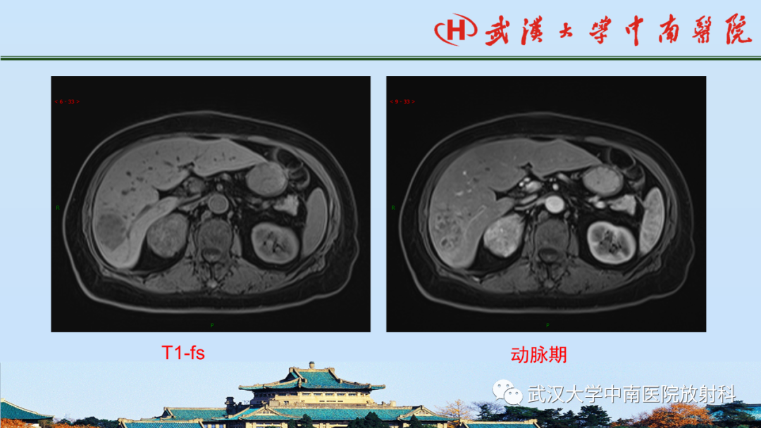 影像PPT - 【PPT】腹盆病例讨论（肾上腺）-9