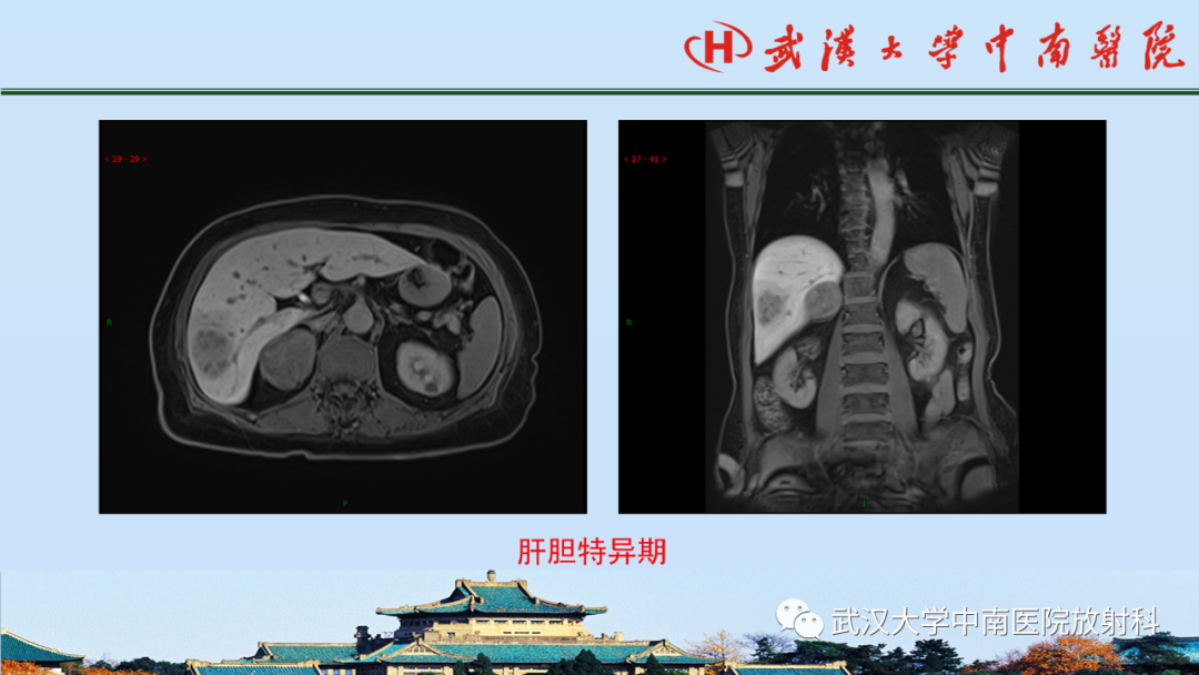 影像PPT - 【PPT】腹盆病例讨论（肾上腺）-11