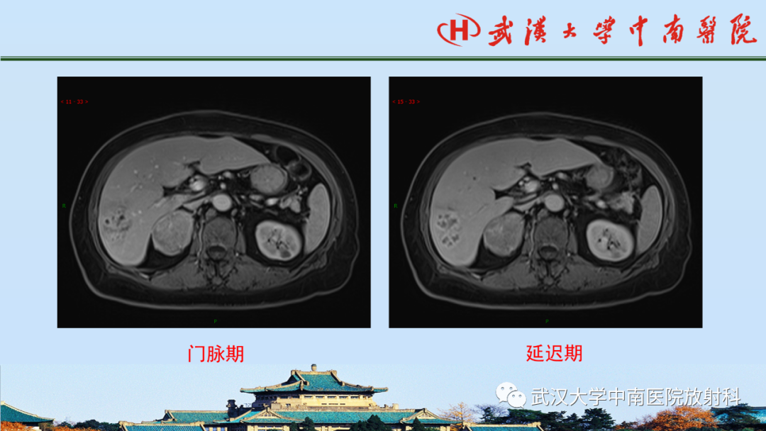 影像PPT - 【PPT】腹盆病例讨论（肾上腺）-10