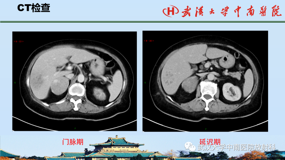 影像PPT - 【PPT】腹盆病例讨论（肾上腺）-4