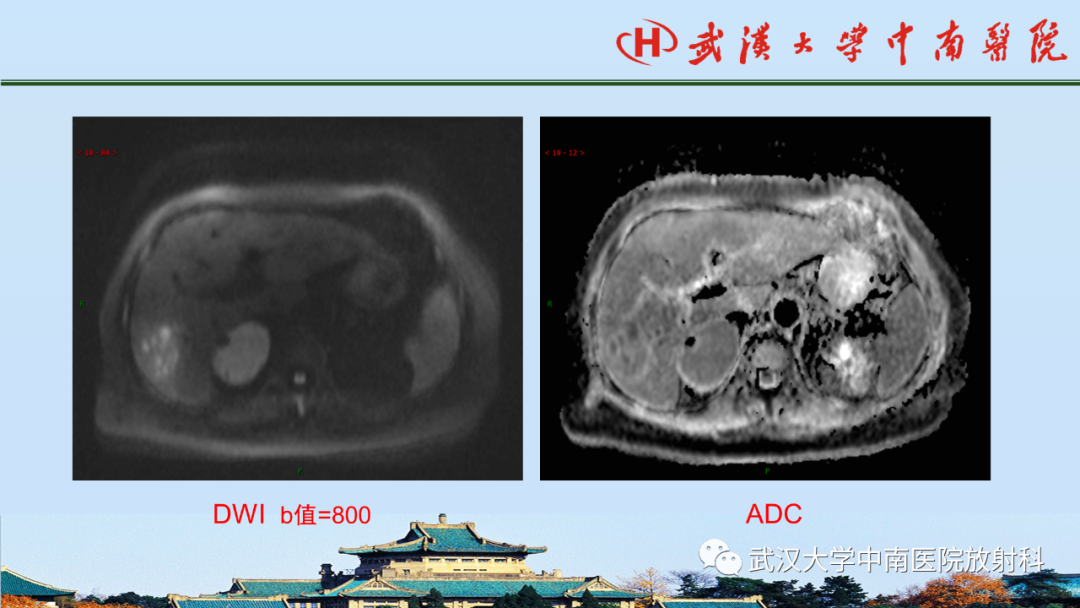 影像PPT - 【PPT】腹盆病例讨论（肾上腺）-8