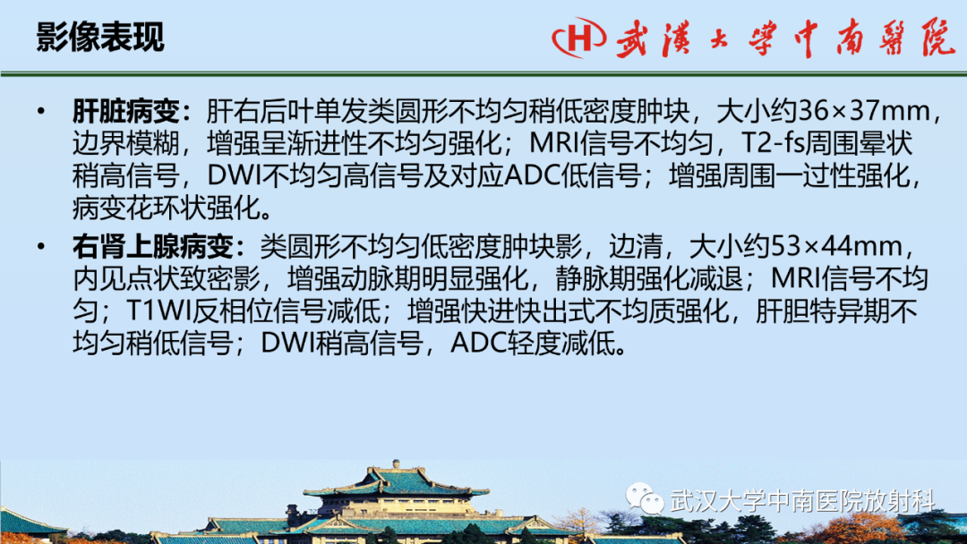 影像PPT - 【PPT】腹盆病例讨论（肾上腺）-12