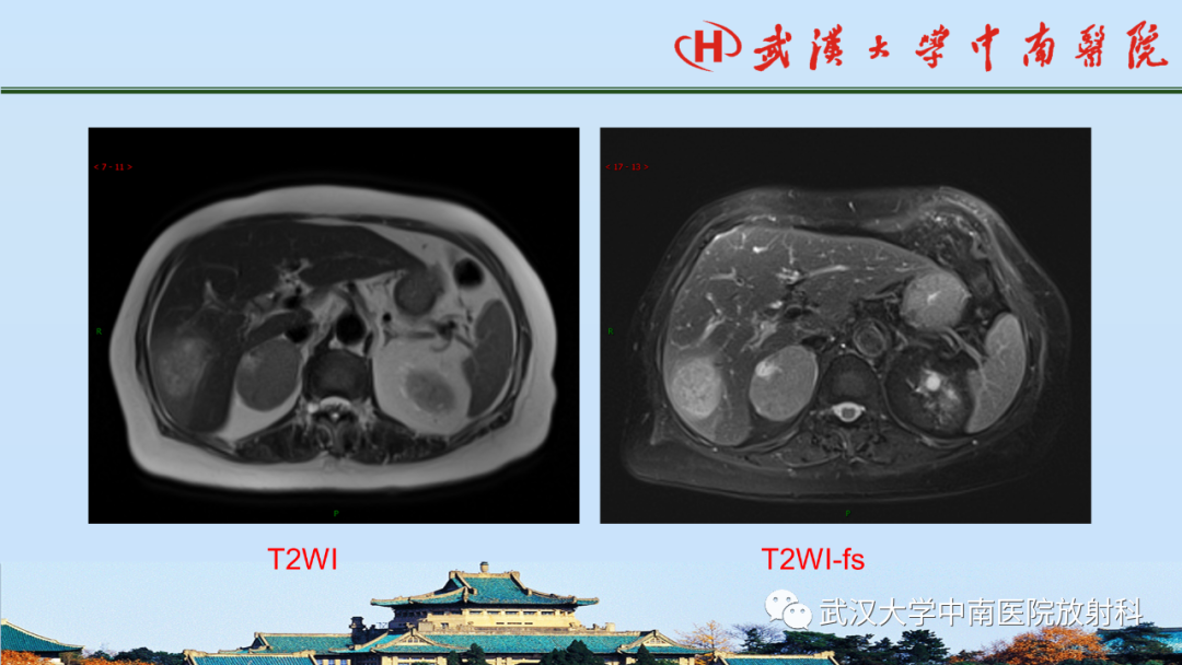 影像PPT - 【PPT】腹盆病例讨论（肾上腺）-7
