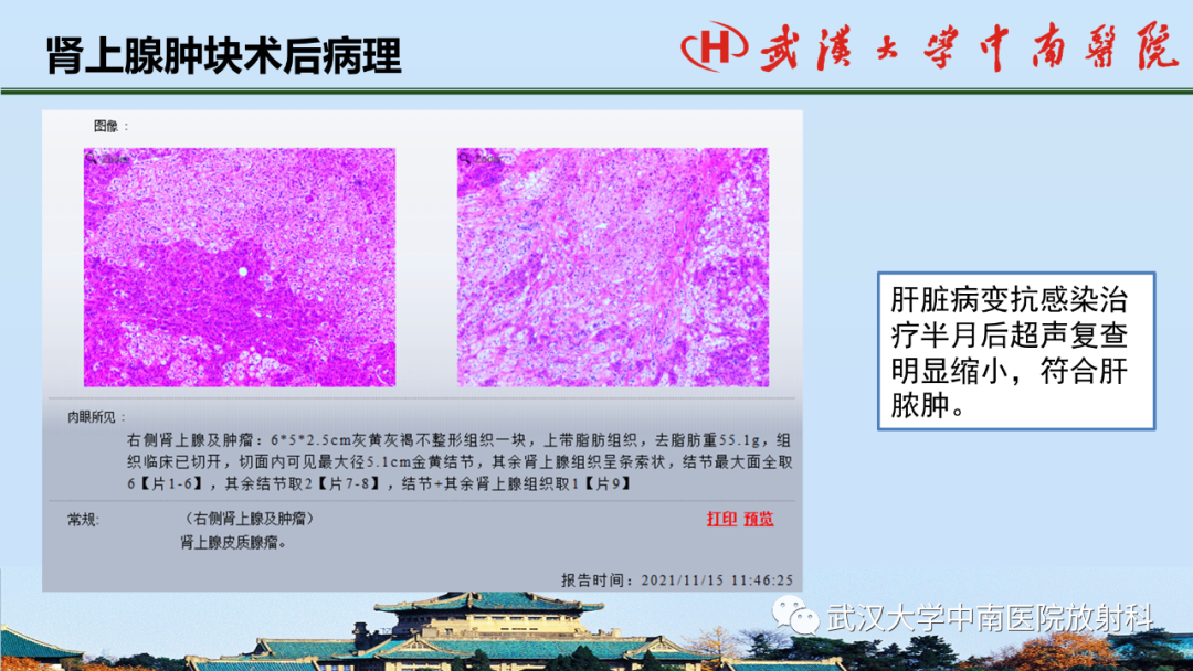 影像PPT - 【PPT】腹盆病例讨论（肾上腺）-15