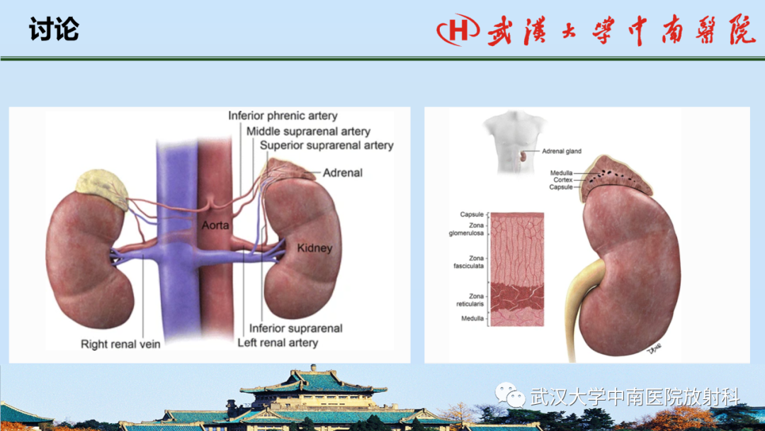 影像PPT - 【PPT】腹盆病例讨论（肾上腺）-16