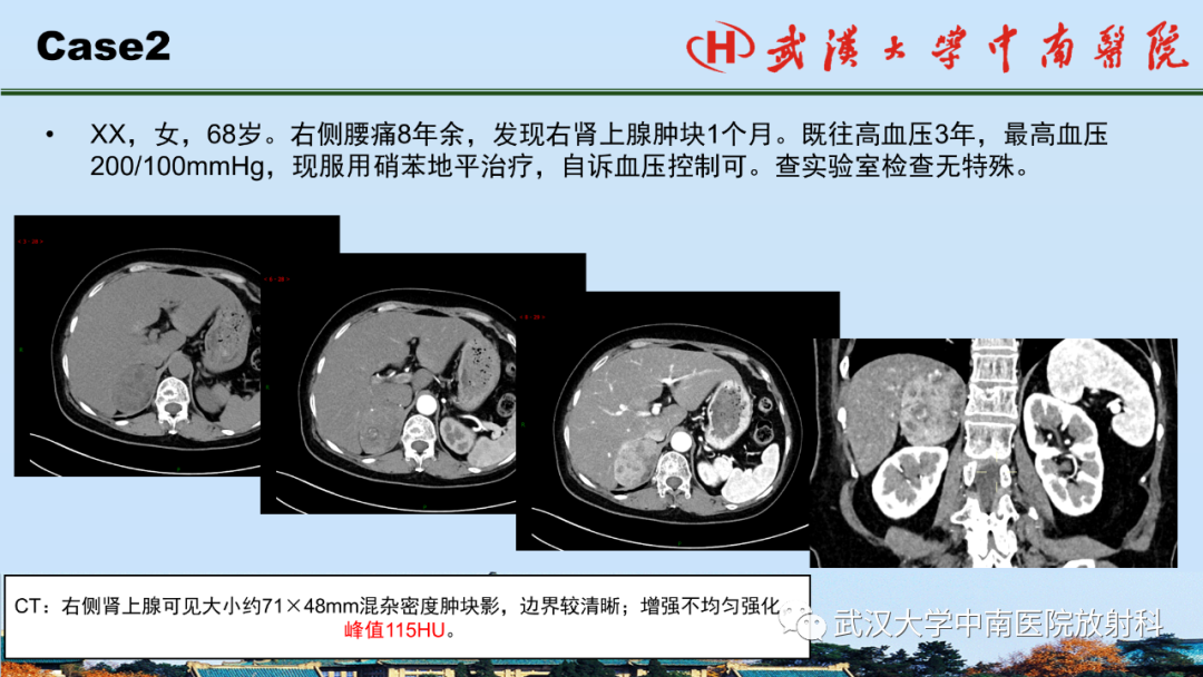 影像PPT - 【PPT】腹盆病例讨论（肾上腺）-19