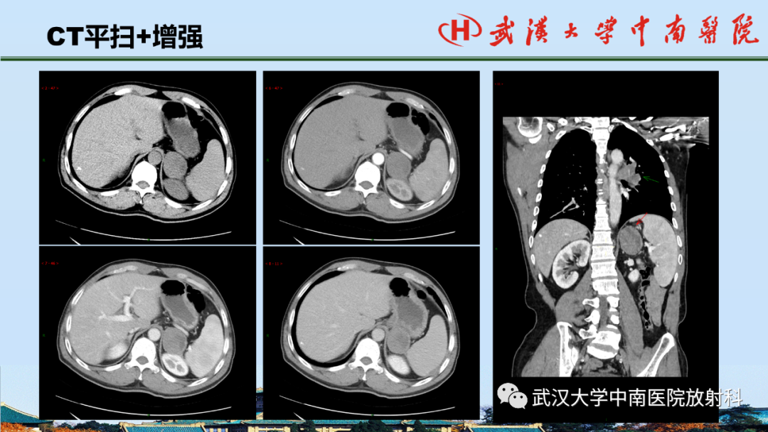 影像PPT - 【PPT】腹盆病例讨论（肾上腺）-22