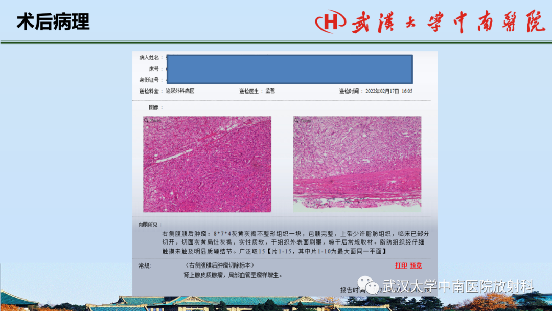 影像PPT - 【PPT】腹盆病例讨论（肾上腺）-20
