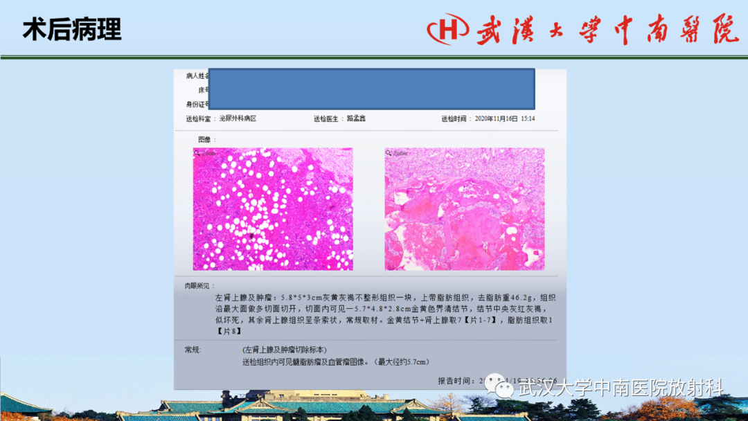 影像PPT - 【PPT】腹盆病例讨论（肾上腺）-25