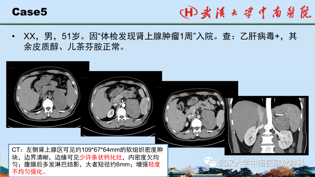 影像PPT - 【PPT】腹盆病例讨论（肾上腺）-26